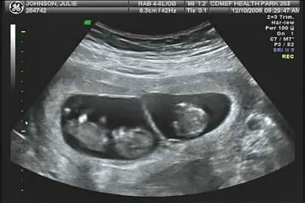 Как протекает беременность двойней | пологовий будинок «Лелека»